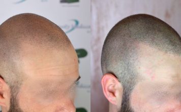 Tricopigmentazione e trapianto di capelli FUE, la strategia giusta tricopigmentazione e trapianto FUE ricevente